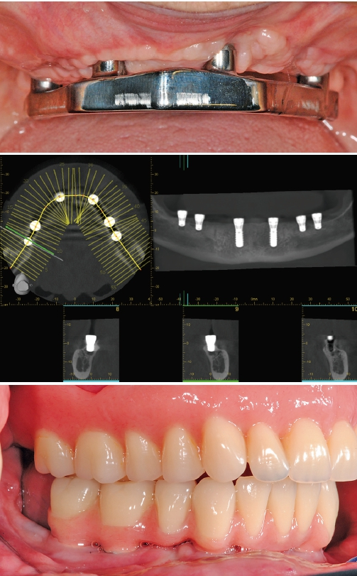 Abb. 3a–c: Bei Zahnlosigkeit lässt sich Patienten bei entsprechender Indikation die abnehmbare auf Implantaten und Steg verankerte Prothetik empfehlen. Sie ist hygienefähig und kommt dem Wunsch nach festsitzenden Zähnen am nächsten.