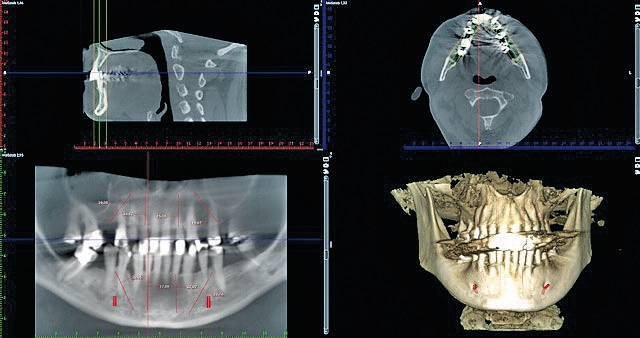 Abb. 5: Virtuelle Planung der Implantatpositionen und -angulationen auf Grundlage einer DVT-Aufnahme.