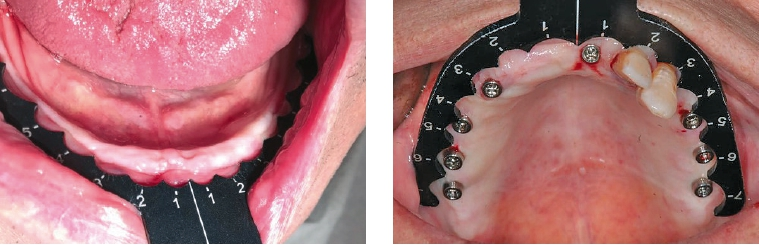 Abb. 3 und 4: Champions-Guides ist ein wichtiges Tool zur prothetisch korrekten Lagebestimmung von Zahnimplantaten. Eine Schablone ist für den UK, die andere für den OK – immer wieder form-, sterilisier- und einsetzbar.