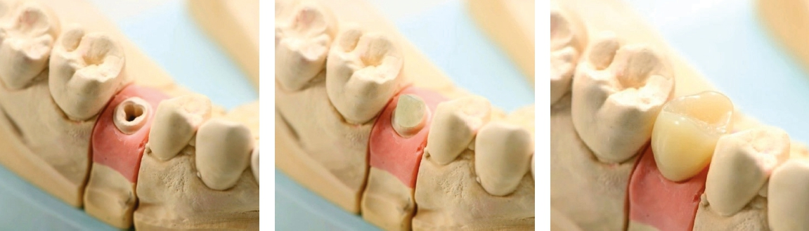 Abb. 5-7: Das zahntechnische Labor gießt das Modell in Superhartgips mit Zahnfleischmaske aus (ohne Laboranalog!). Man fixiert und präpariert den Glasfaser-Abutment Aufbau, den man mit der Implantatlieferung gleich mit erhält und fertigt die Krone an.