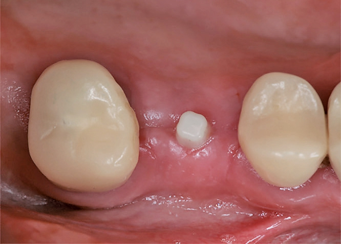 Reizlose Mukosa am transgingival eingeheilten ceramic.implant in regio 16.