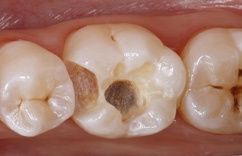 Abb. 3: Nach der Kariesentfernung wurde die Kavität finiert.