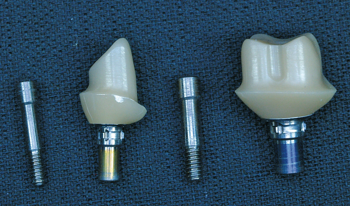 Abb. 2b: Verklebte individuelle Abutments für die Regionen 12 und 26.