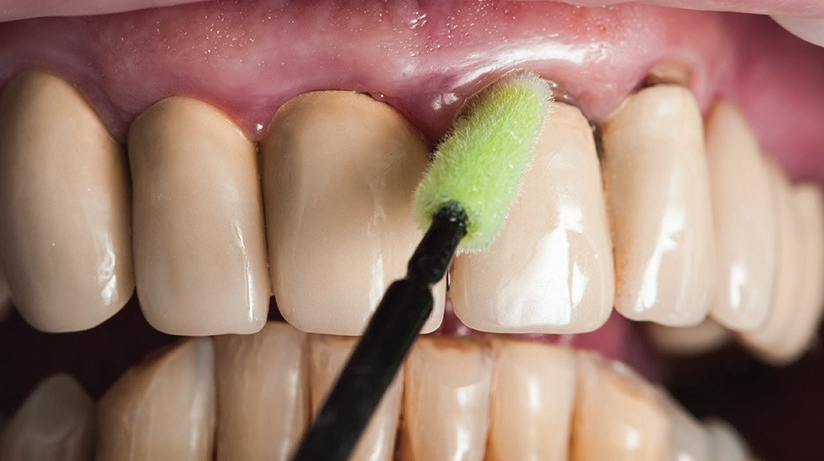 Abb. 3: Zum Abschluss der professionellen Zahnreinigung erfolgt die Applikation eines Schutzlackes mit Chlorhexidin entlang des Gingivalsaumes.