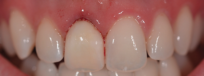 Abb. 6: Röntgenkontrollaufnahme nach Implantation (mit vorübergehend eingesetztem Gingivaformer).