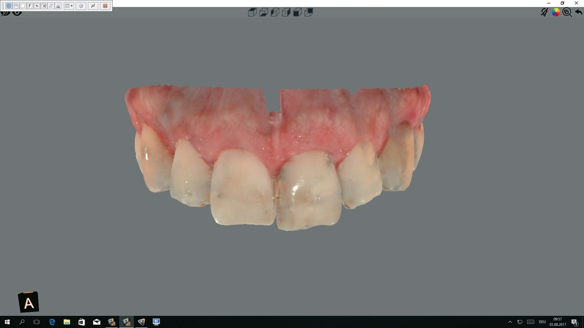 Abb. 3: Intraoralscan der Ausgangssituation..