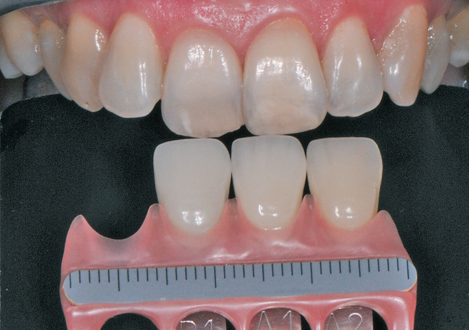Abb. 3: Bestimmen der Grundzahnfarbe (Dragon Shade, Drachenberg & Bellmann).