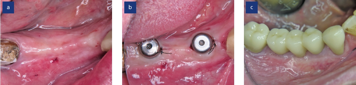 Abb. 3: Weichgewebsheilung drei Monate nach Implantation (a), Platzierung von Gingivaformern (b), finale prothetische Versorgung des augmentierten Unterkiefers (c).