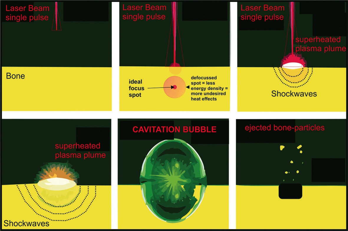 Abb. 3: Graphische Darstellung der physikalischen Effekte eines einzelnen Laserpulses auf Knochengewebe (photoakustischer Effekt und Kavitations-Effekt). Wenn der Laserpuls perfekt fokussiert auf den Knochen trifft, wird die Hitzeenergie des unsichtbaren Infrarot-Lichtstrahls sofort komplett vom extra- und intrazellulären Wasser und HA absorbiert und eine Dampfblase aus supererhitztem Wasserdampf entsteht („superheated plasma plume“) Diese wiederum löst die akustische Schockwelle mit ca. 120 dB Schalldruck aus („Shockwaves“). Die explosionsartige Expansion der Plasmablase bewirkt den Kavitationseffekt („CAVITATION BUBBLE“), der die zuvor durch die akustische Schockwelle frakturierten Knochenpartikel aus dem Osteotomiespalt schleudert und den Knochen weiter „exkaviert“. Wenn der Laserstrahl defokussiert wird (rote gepunktete Linien), wird der Knochen lediglich karbonisiert (verkohlt), da ie Energie für die Bildung einer Kavitationsblase nicht ausreicht.