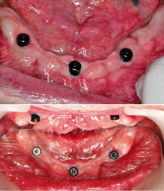 Abb. 4 und 5: Die geraden Novaloc® Sekundärteile wurden nach zwei Monaten in die Unterkiefer-Implantate geschraubt.