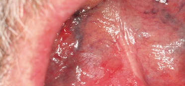 Abb. 3: Die klinisch als homogene Leukoplakie imponierende Schleimhautveränderung wies histopathologisch hochgradige Epitheldysplasien auf und war ein Carcinoma in situ.