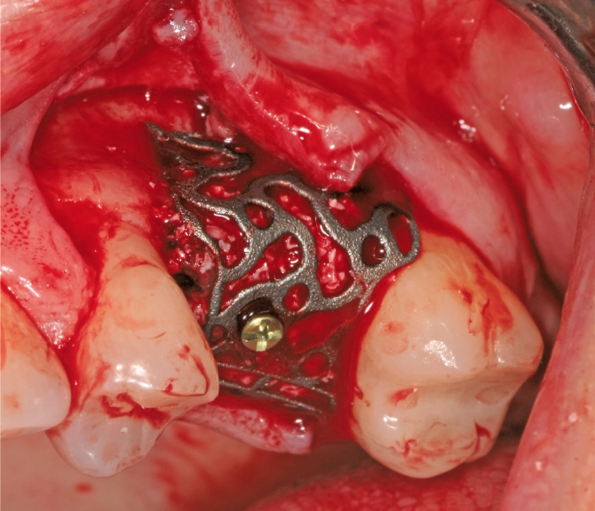Abb. 3: Einbringen des Titangitters: Fixation des beladenen Titangitters (Bio-Oss®, Geistlich Biomaterials) an die optimale Position gemäß der virtuellen Planung.