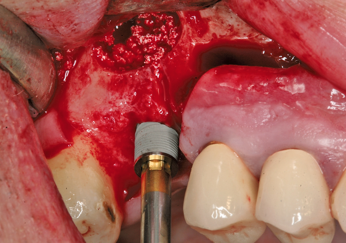 Abb. 3: Simultane Insertion eines Standardimplantates (blueSKY D4 L12, bredent medical, Senden).