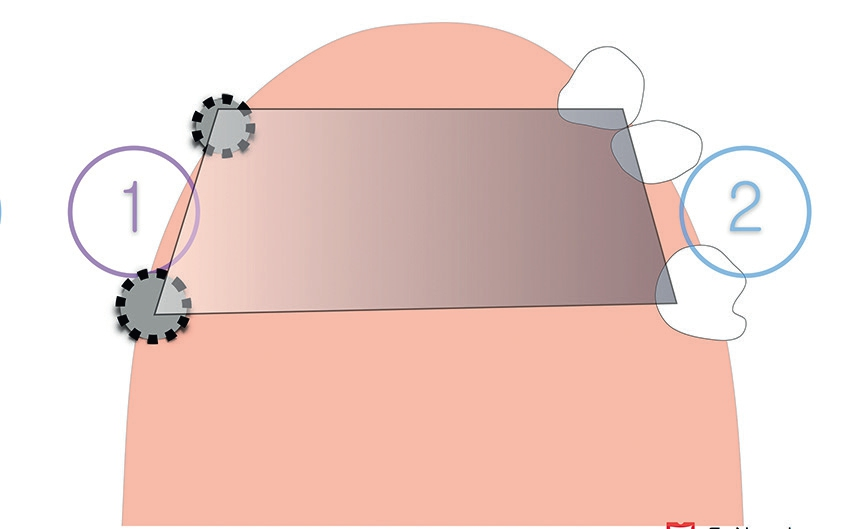 Schema 2: Größeres Stützpolygon durch Einbeziehung von 2 Implantaten im 1. Quadranten.