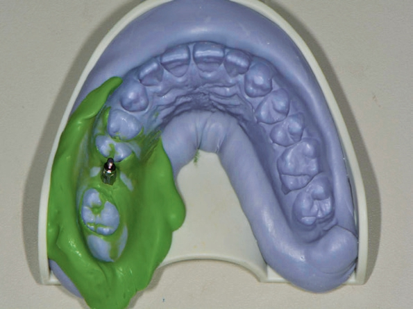 Abb. 3: Einsicht in den Implantatabdruck, Abformpfosten in situ.