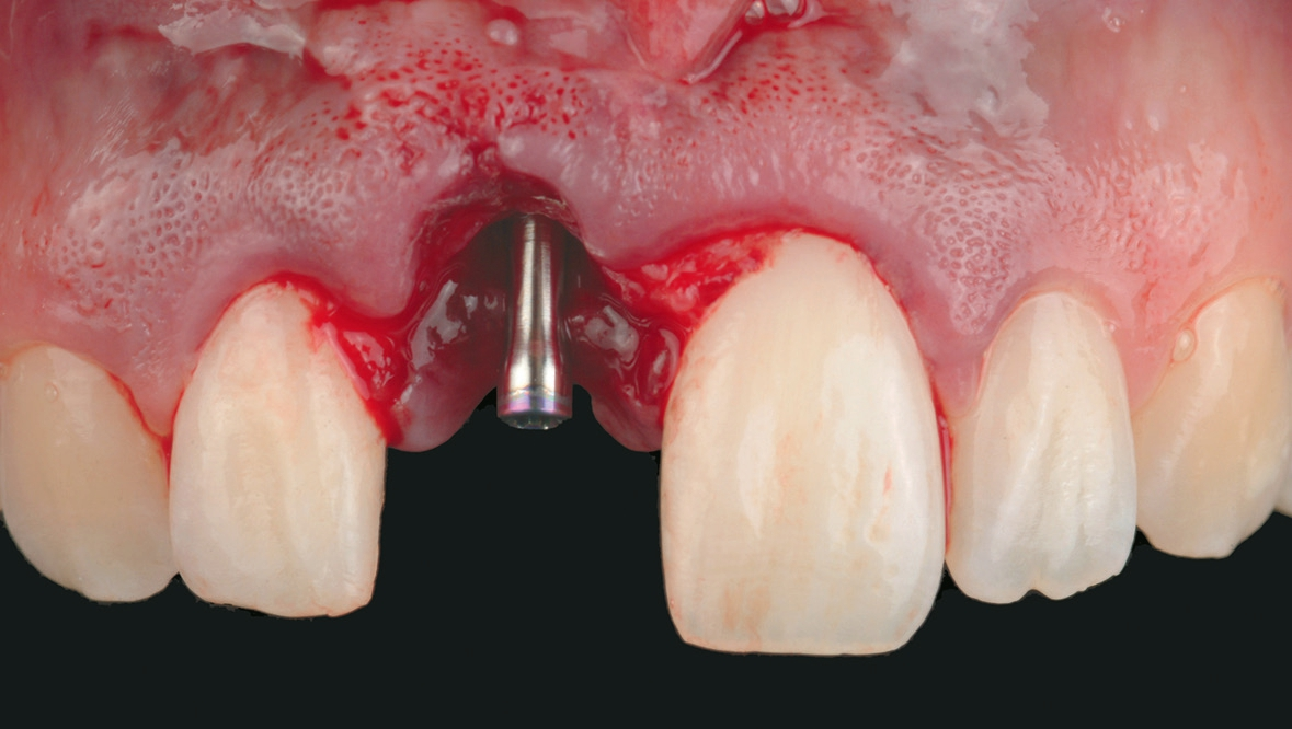 Ein 7 mm hoher Slim Gingivaformer wurde mit einem NobelParallel CC Implantat (3,5 × 13 mm) verbunden. Mit dem Slim Gingivaformer kann der Raum für Gewebetransplantate vergrößert und der primäre Wundverschluss erleichtert werden.