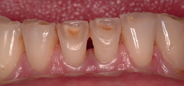 Abb. 3: Lokal begrenzte Attritionen, insbesondere an den unteren mittleren Schneidezähnen.