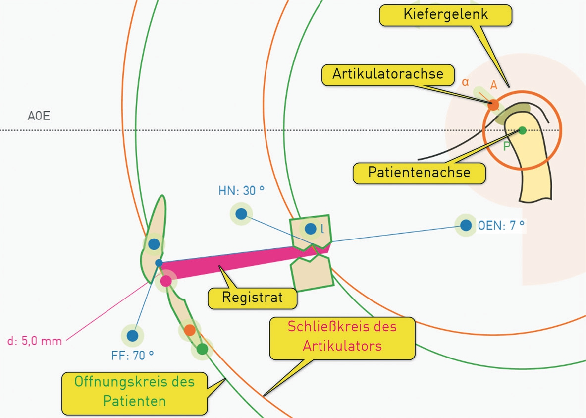 Abb. 3: Simulation der Problematik unterschiedlicher Bewegungskreise bei Höhenänderung und nicht übereinstimmenden Rotationsachsen von Patient und Artikulator.