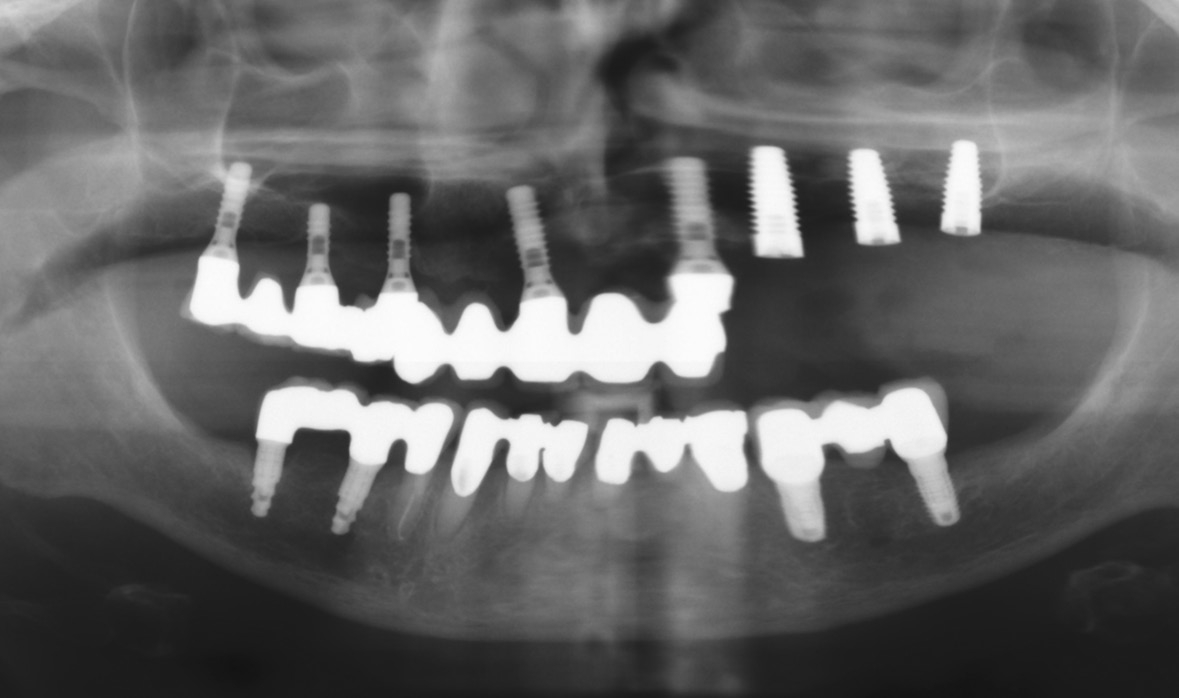 Abb. 3: OPG nach Implantation.