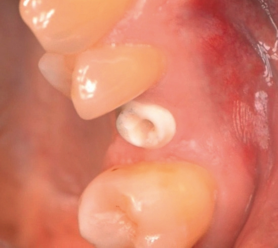 Abb. 3: BioWin! Implantat in situ.