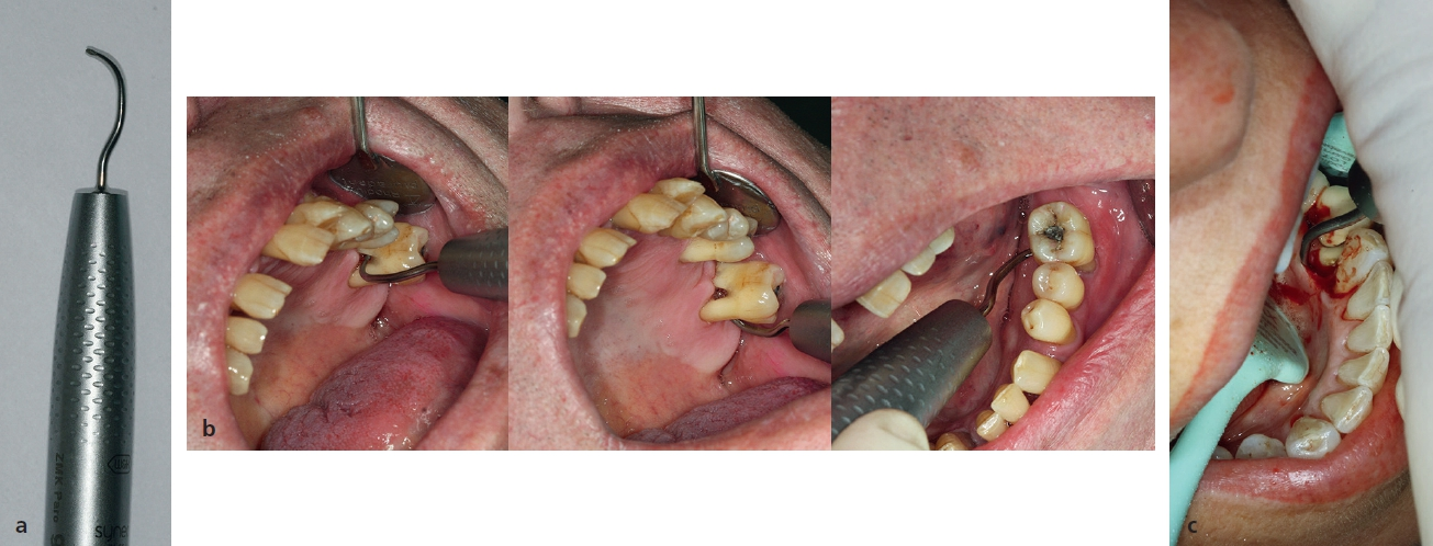 Abb. 3 a) Schallscaler mit knospenförmiger Arbeitsspitze (3AP, W&H, Bürmoos/Österreich) b) bei subgingivaler Instrumentierung der durchgehend tastbaren Furkationen an Zahn 26 und 36 im Rahmen der aktiven Parodontitistherapie sowie c) im Rahmen eines parodontalchirurgischen Eingriffes mit Zugangslappenoperation an Zahn 34 (gut sichtbar: subgingivale Konkremente mesial auf der Wurzeloberfläche des Zahnes).