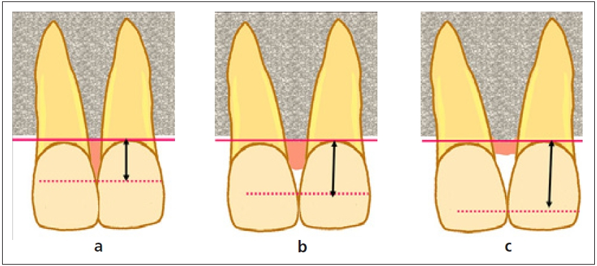 Abb. 2a–c: a) Darstellung einer physiologischen Distanz zwischen Kontaktpunkt und Alveolarknochen. Der Approximalraum ist mit Papille aufgefüllt. b) Darstellung einer vergrößerten Distanz (6 mm) zwischen Kontaktpunkt und Alveolarknochen. Der Approximalraum ist zu 50% mit Papille aufgefüllt. c) Darstellung einer vergrößerten Distanz (7 mm und mehr) zwischen Kontaktpunkt und Alveolarknochen. Die Papille ist nicht mehr vorhanden.