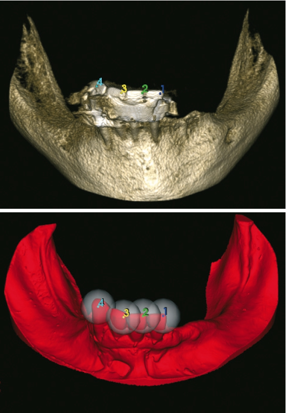 Abb. 3a u. b: Überlagerung der DVT- und STL-Datensätze mit Markierung markanter gleichartiger Bereiche.