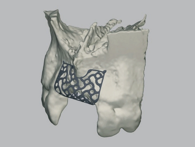 Abb. 3: Ein präzises 3D-Planungsmodell, erstellt auf Basis von DVT-Daten.