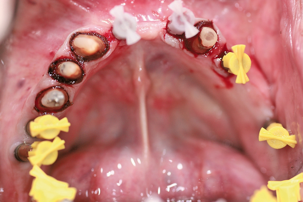 Abb. 3: Die Implantatabformung.