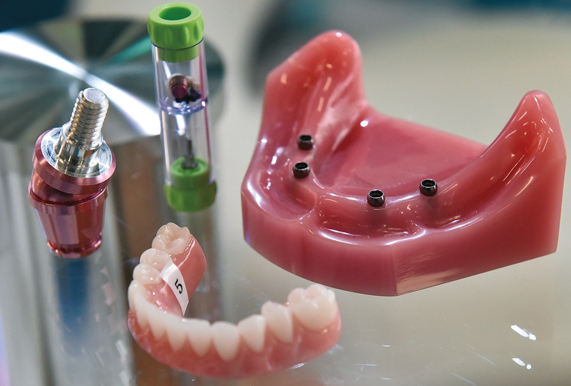 Abb. 4: Bei der Verankerung implantatprothetischer Konstruktionen mit Lokatoren (oft „Vollprothesen-Alternative“) erlaubt eine hohe Schwenkkapazität heute große Divergenzen zwischen zwei Implantaten (z.B. bis zu 40 Grad). Und unter Verwendung eines speziellen Haltemechanismus lässt sich die Prothese mithilfe eines hydraulischen Ablöse-Systems beim Recall-Termin besonders einfach lösen.