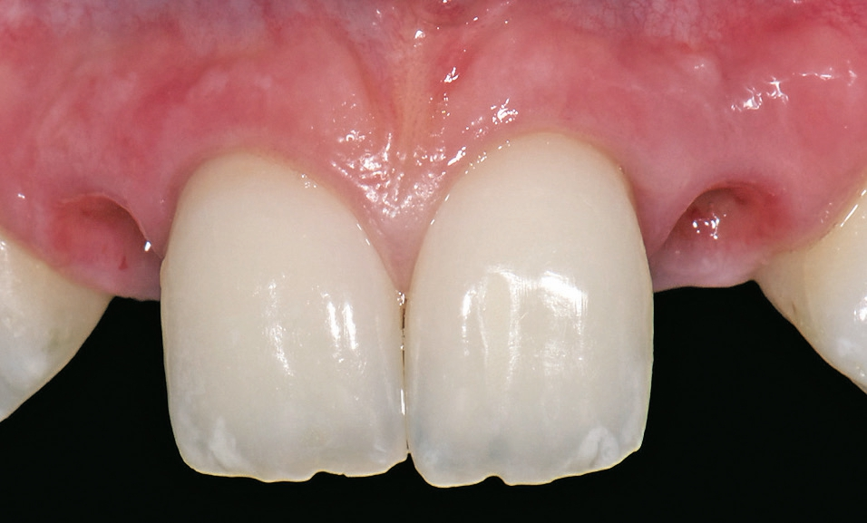 Abb. 3: Freigelegte Implantate.
