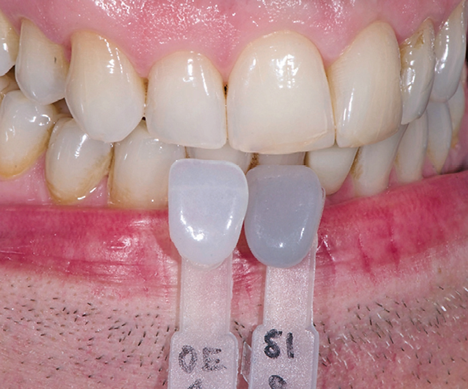 Abb. 3: Bestimmen der lichtoptischen Eigenschaften mit speziellen Farbstäbchen (hier Opal-Effectmassen).