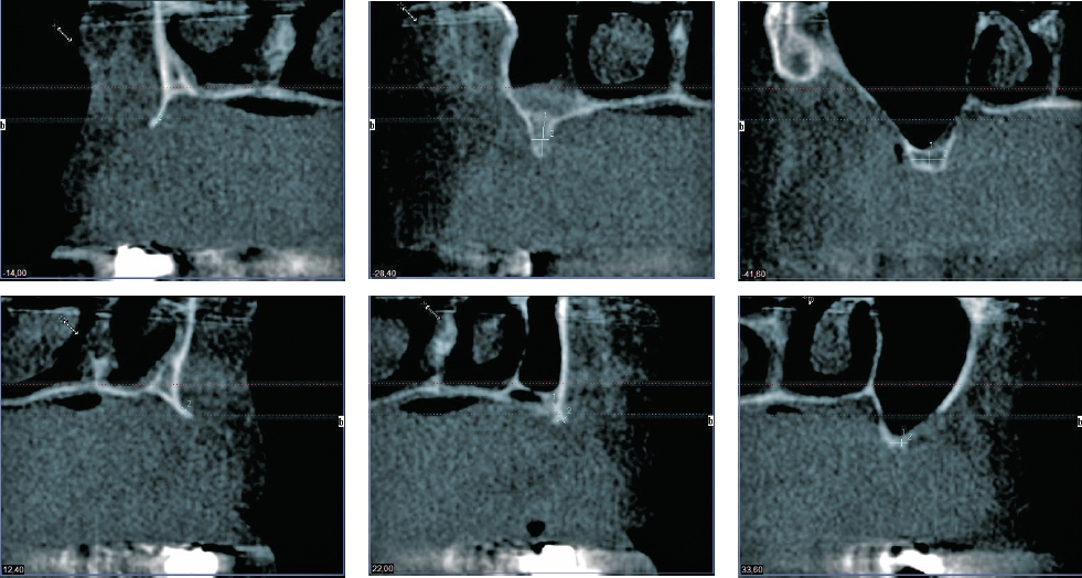 Abb. 7: Transversale Schichtung des ortständigen Knochens im DVT vor Anbringen der allogenen Knochenblöcke. Die Darstellung zeigt die reduzierte Restknochenhöhe und die Knochenkontaktfläche, die zur Reorganisation der Blöcke zur Verfügung steht. Obere Reihe: regio 12-14-16, untere Reihe: regio 22-24-26.