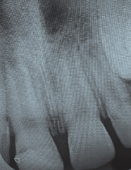 Abb. 3: Ausgangszustand nach dentalem Trauma mit komplizierter Schmelz-Dentin-Fraktur.