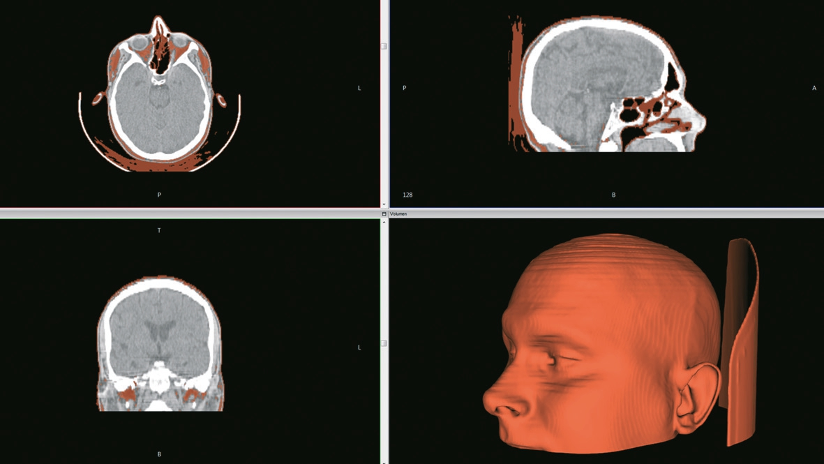 Abb. 3: Beispiel der Erstellung von Weichteilkonturen aus einem CT-Datensatz.