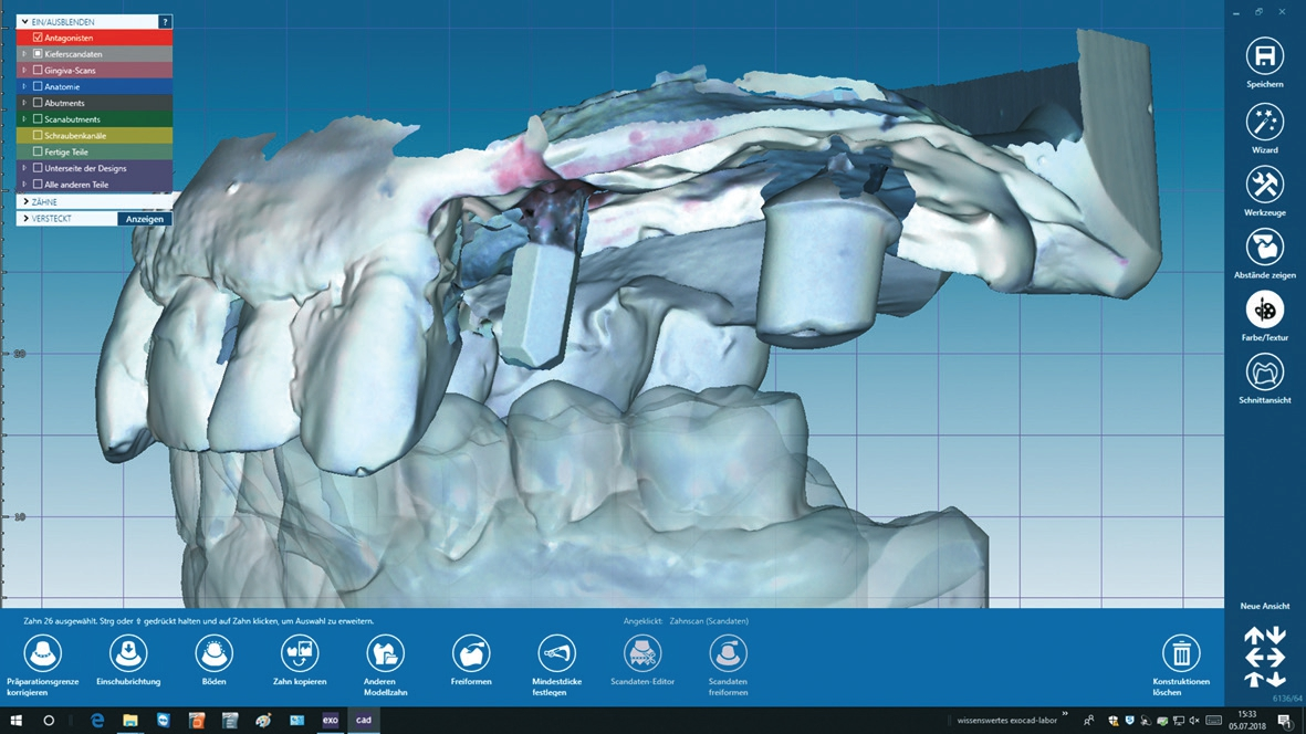Abb. 3: Eingelesener Scan mit Scanbody i.r. 24.