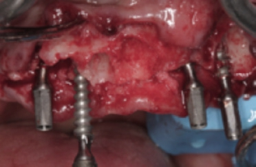Abb. 3: Die Insertion der Interimsimplantate.