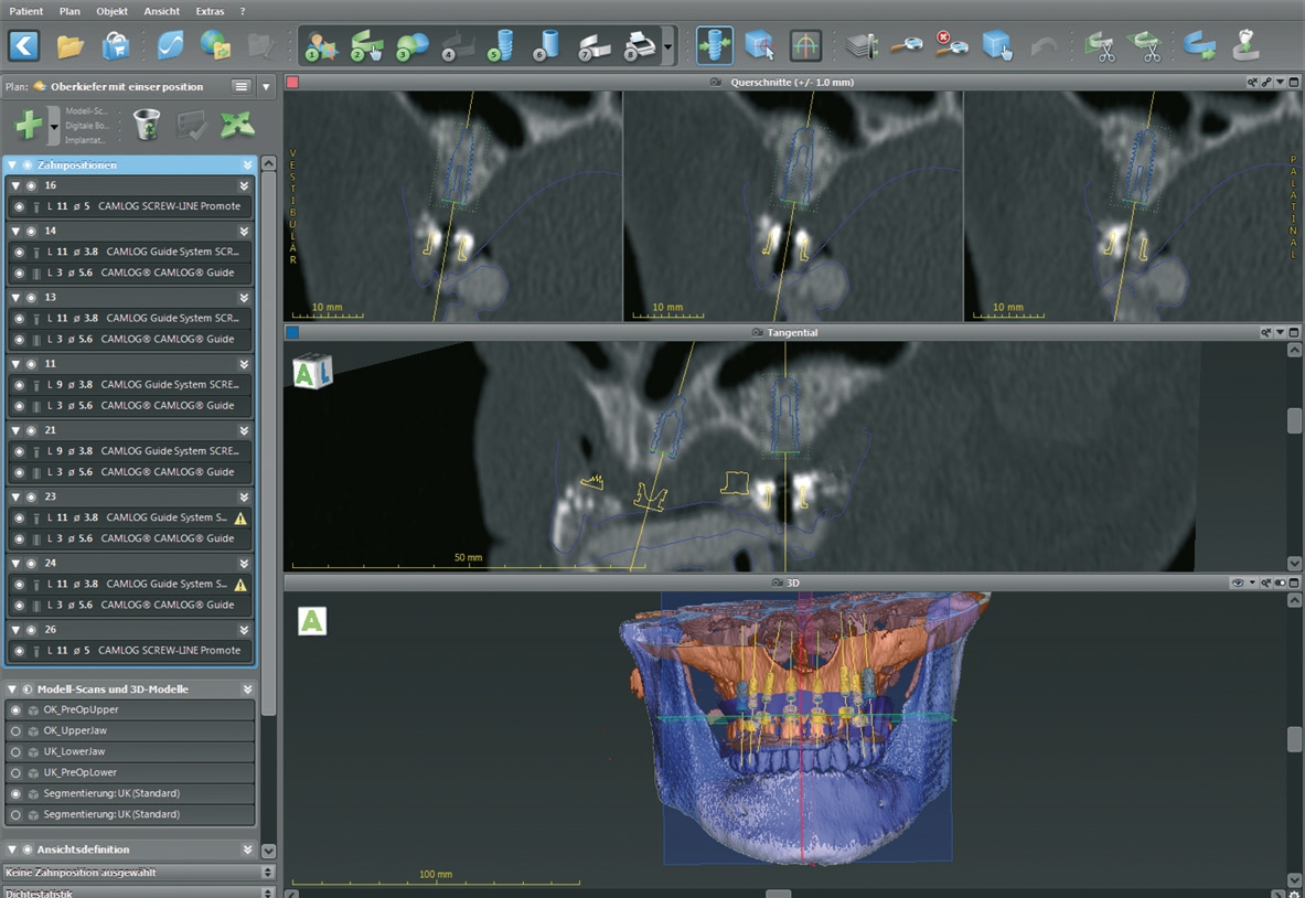 Abb. 3: Screenshot der virtuellen Implantatplanung im Oberkiefer (Labor Cera-Technik, München).