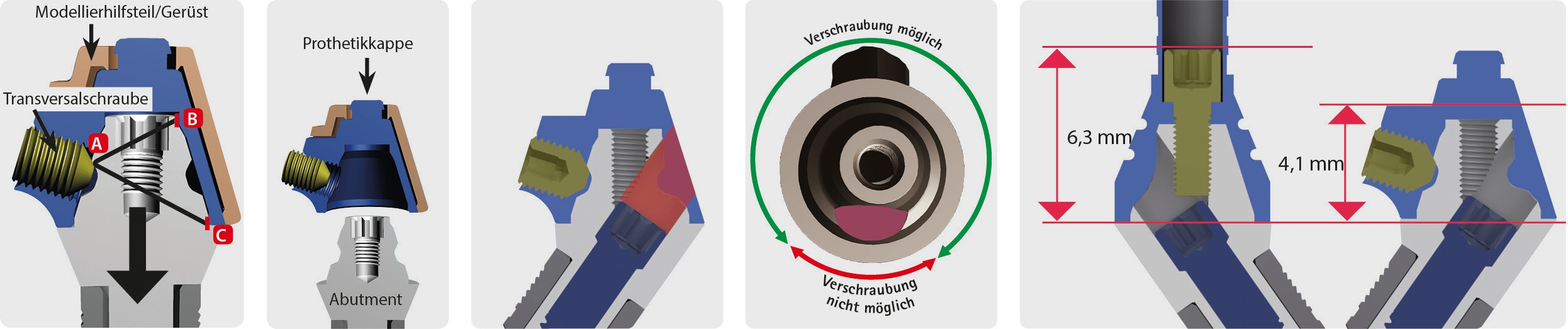 Abb. 4: Grafische Darstellung der transversalen Verschraubung. Das Gewinde für die Bolzenschraube sitzt im Brückengerüst. Die Bolzenschraube (A) und die zylindrischen Flächen (B und C) bilden eine Einheit. Die Befestigung der Prothetikkappe erfolgt als Drei-Punkt-Fixierung über die Bolzenschraube und die zylindrischen Flächen. Durch die kurzen zylindrischen Flächen arretiert sich die Kappe beim Aufsetzen selbstständig.