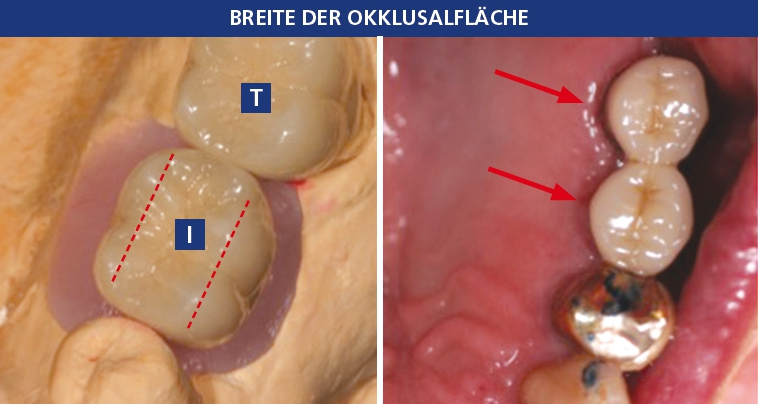Abb. 2a: Vergleich der natürlichen Zahnkrone des zweiten Molars (T) und der Implantatkrone im Bereich des ersten Molars (I); die Okklusalfläche der Implantatkrone ist zu groß und sollte rekonturiert werden. Abb. 2b: Idealer okklusaler Tisch mit minimaler Höckerhöhe.