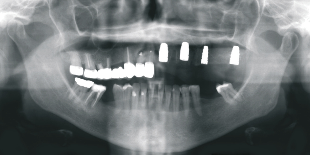 Abb. 3: OPG nach Extraktion und Sofortimplantation 21, 23, 27(8) und Insertion 25.