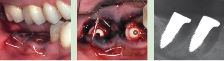 Abb. 3 bis 5: Zahnentfernung und Implantation sowie Röntgenkontrolle unmittelbar nach Sofortimplantation.