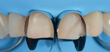 Abb. 3: Die Unica anterior-Matrizen auf den mittleren Schneidezähnen platziert. In diesem Fall sorgten die intrinsische Festigkeit der Stahlmatrizen und die vorhandenen intakten Kontaktpunkte für eine gute Stabilität und Fixierung der Matrizen, ohne dass der Einsatz von Keilen oder Kunststoff nötig war. Darüber hinaus ermöglicht die konvexe Form der Matrizen eine effektivere Platzierung des Kofferdams im Zervikalbereich, sodass eine bessere Isolierung des Operationsgebiets gewährleistet ist.