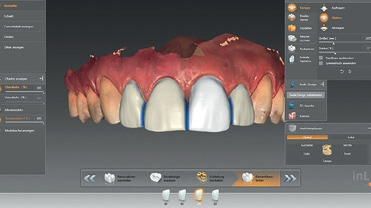 Abb. 3: Dreidimensionales virtuelles Wax-up auf Basis des DSD in der inLab-Software.