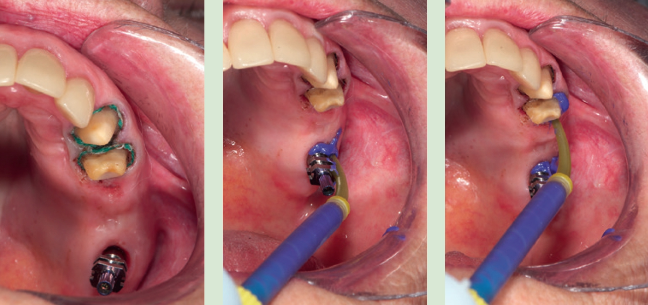 Abb. 3–5: Gelegte Retraktionsfäden, Umspritzen des Implantatabformpfostens und der Zähne 23 und 24.