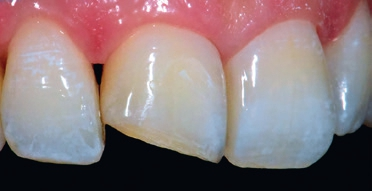 Abb. 3: Zustand nach Entfernung des Komposits.