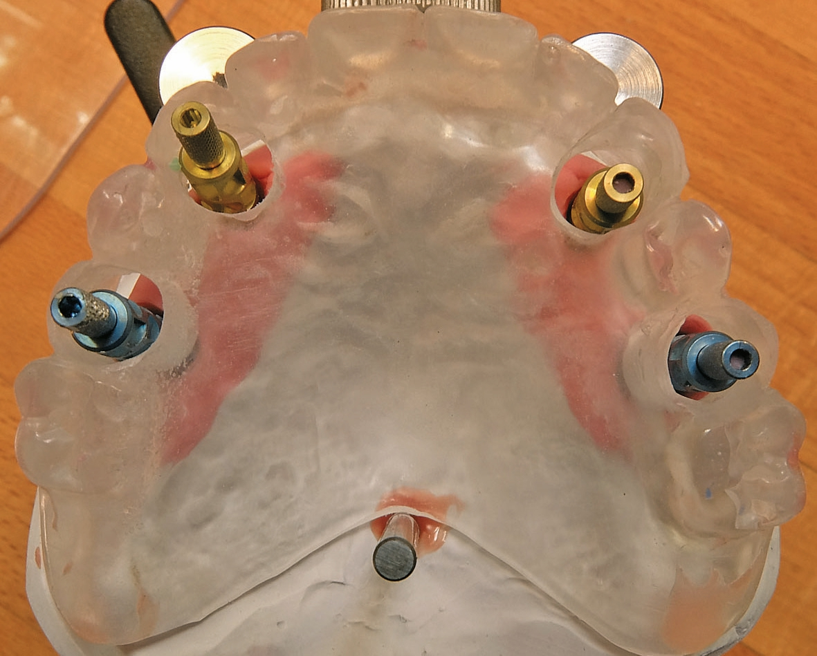 Abb. 62: Die Implantate standen exakt an der geplanten Position, sodass die Abutments ebenfalls problemlos konstruiert und integriert werden konnten.