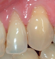 Abb. 3: Zahn 23 (Restauration mit G-BOND) und Zahn 24 (Restauration mit Optibond FL) zu Untersuchungsbeginn.