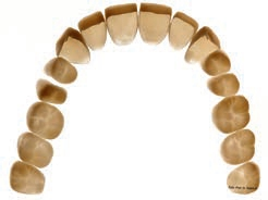 Abb. 3: CAD/CAM-gefertigte, langzeitprovisorische Kauflächen-Veneers aus Polymer.