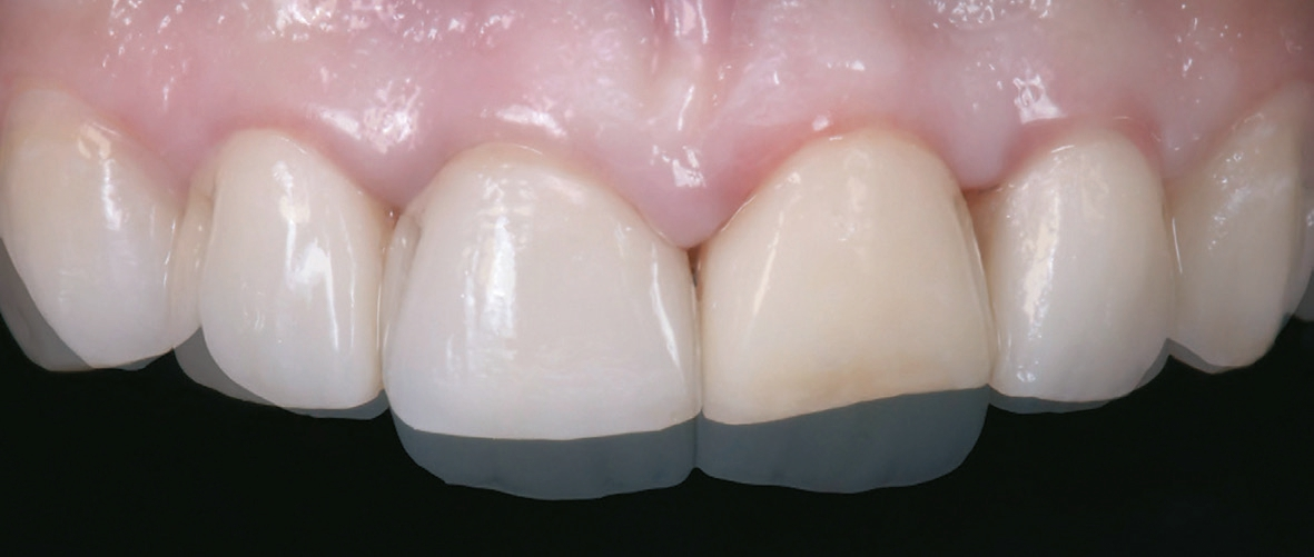 Abb. 3: Smile Design mit neuen Längen und Breiten der Schneidezähne gemäß digitaler Gestaltung.